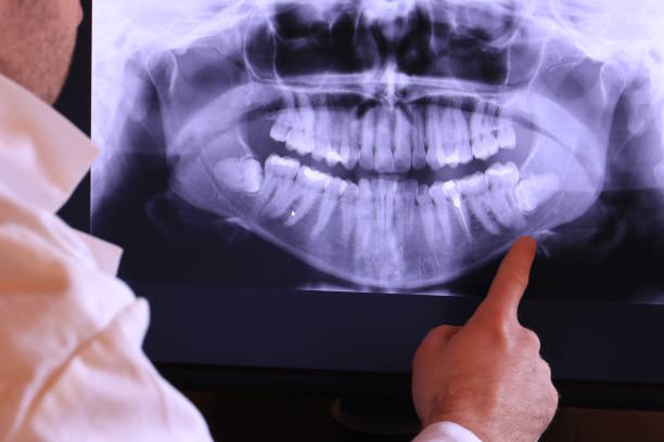 Best Emergency Wisdom Tooth Extraction in Glendale, CA