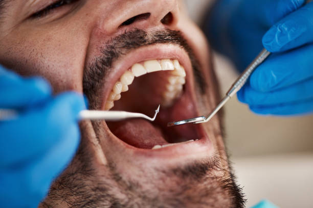 Best Knocked-Out Tooth (Avulsed Tooth) Treatment in Glendale, CA